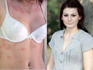 allergy for water
